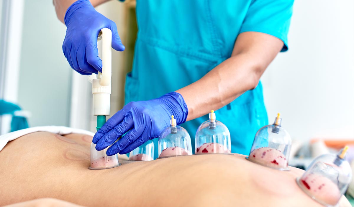 hijama (wet cupping) hijama (wet cupping)