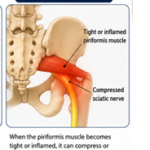 Best Sciatica Treatment in Sharjah | TAM Physio & Rehab Clinic 10 therapist performing priformis syndrome test