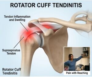 Shoulder Pain Treatment in Sharjah | Tam Physio & Rehab Clinic 9 Rotator Cuff Tendinitis
