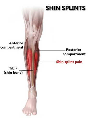 Shin_Splint_treatment_at_Tam_Physio_Clinic_Sharjah-UAE