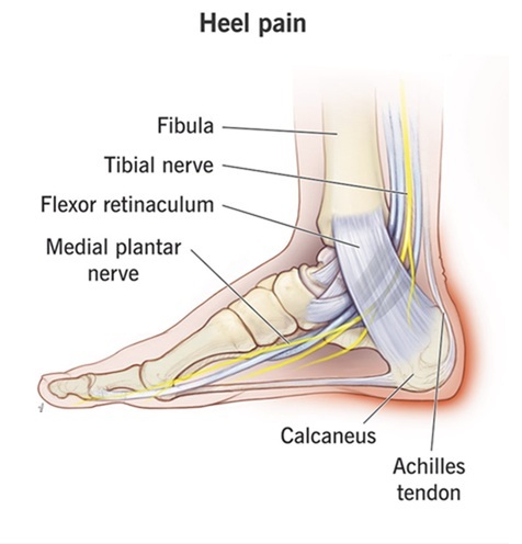 plantar_fascitis_treatment_done _at_Tam_Physio_rehab