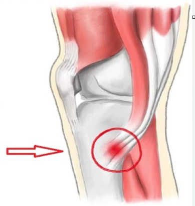 Knee ligament examination including ACL, MCL and LCL stability tests