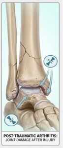 Post Traumatic Arthritis