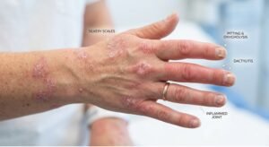 Psoriatic Arthritis Diagnosis and Treatment at TAM Physio & Rehab Majaz-1 Sharjah