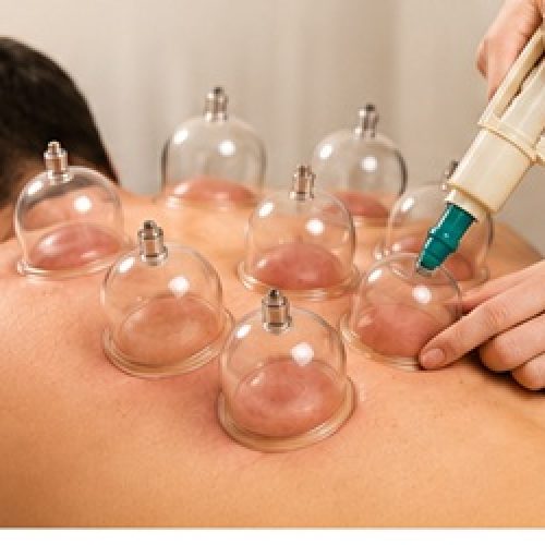 Our Story 12 Professional cupping therapy treatment for back pain relief at a physiotherapy clinic in Sharjah UAE.